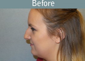Milwaukee Plastic Surgery - Rhinoplasty - 12-5
