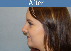 Milwaukee Plastic Surgery - Rhinoplasty - 12-6