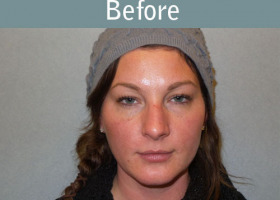 Milwaukee Plastic Surgery - Rhinoplasty - 13-1