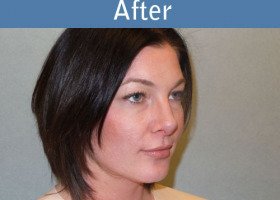 Milwaukee Plastic Surgery - Rhinoplasty - 13-4