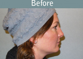Milwaukee Plastic Surgery - Rhinoplasty - 13-5