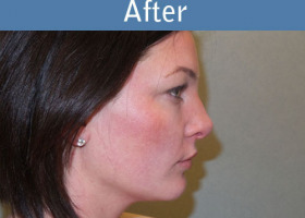Milwaukee Plastic Surgery - Rhinoplasty - 13-6