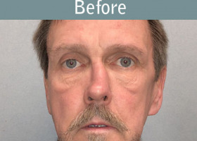 Milwaukee Plastic Surgery - Rhinoplasty - 14-1