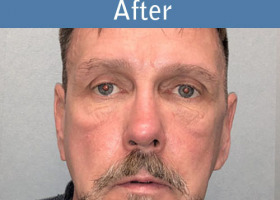 Milwaukee Plastic Surgery - Rhinoplasty - 14-2