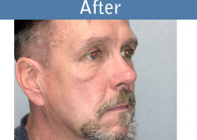Milwaukee Plastic Surgery - Rhinoplasty - 14-4