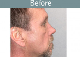 Milwaukee Plastic Surgery - Rhinoplasty - 14-5