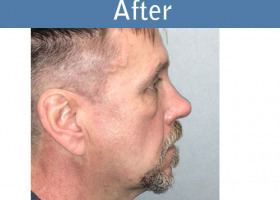 Milwaukee Plastic Surgery - Rhinoplasty - 14-6
