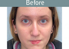 Milwaukee Plastic Surgery - Rhinoplasty - 15-1