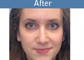 Milwaukee Plastic Surgery - Rhinoplasty - 15-2