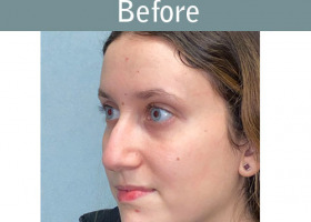 Milwaukee Plastic Surgery - Rhinoplasty - 15-3