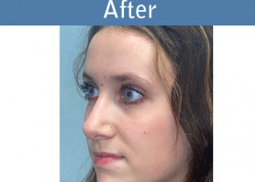 Milwaukee Plastic Surgery - Rhinoplasty - 15-4