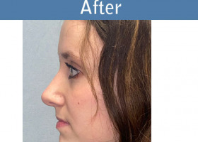 Milwaukee Plastic Surgery - Rhinoplasty - 15-6