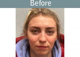 Milwaukee Plastic Surgery - Rhinoplasty - 16-1