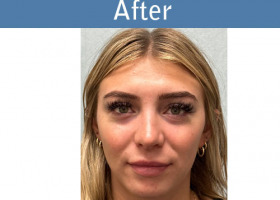 Milwaukee Plastic Surgery - Rhinoplasty - 16-2