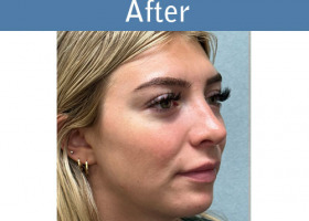 Milwaukee Plastic Surgery - Rhinoplasty - 16-4