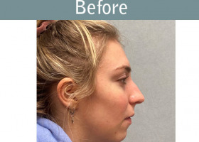 Milwaukee Plastic Surgery - Rhinoplasty - 16-5