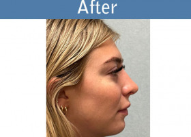 Milwaukee Plastic Surgery - Rhinoplasty - 16-6