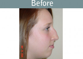 Milwaukee Plastic Surgery - Rhinoplasty - 2-1