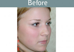 Milwaukee Plastic Surgery - Rhinoplasty - 3-1