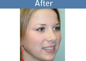 Milwaukee Plastic Surgery - Rhinoplasty - 3-2