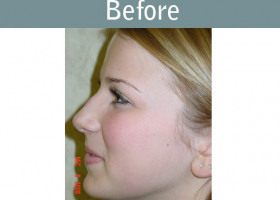 Milwaukee Plastic Surgery - Rhinoplasty - 4-1