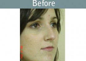 Milwaukee Plastic Surgery - Rhinoplasty - 5-1