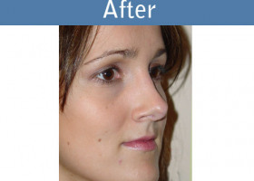 Milwaukee Plastic Surgery - Rhinoplasty - 5-2