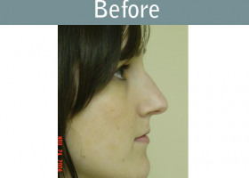 Milwaukee Plastic Surgery - Rhinoplasty - 6-1