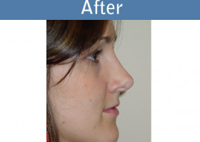 Milwaukee Plastic Surgery - Rhinoplasty - 6-2