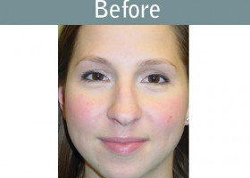 Milwaukee Plastic Surgery - Rhinoplasty - 7-1