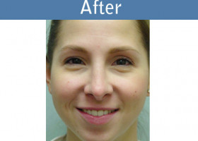 Milwaukee Plastic Surgery - Rhinoplasty - 7-2