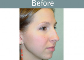 Milwaukee Plastic Surgery - Rhinoplasty - 8-1