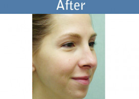 Milwaukee Plastic Surgery - Rhinoplasty - 8-2