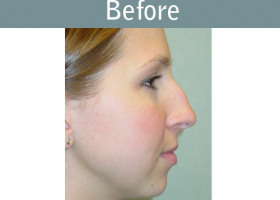 Milwaukee Plastic Surgery - Rhinoplasty - 9-1