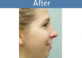 Milwaukee Plastic Surgery - Rhinoplasty - 9-2