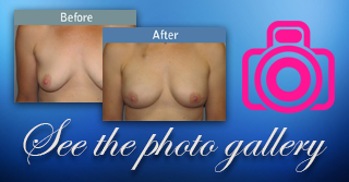 breast_reconstruction_direct_to_implant